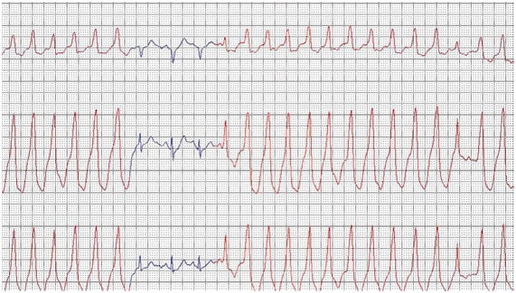 indicador-eletrocardiograma